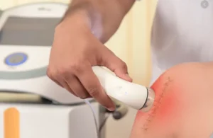 Điều trị sẹo rỗ bằng sóng âm (Ultrasound)