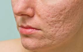 Điều trị sẹo rỗ bằng công nghệ hiện đại: Phương pháp nào phù hợp?
