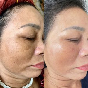 3 Phương Pháp Trị Nám Da Tại Nhà Hiệu Quả Từ Thiên Nhiên