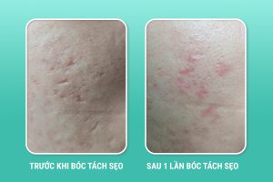 7 Cách Điều Trị Sẹo Hiệu Quả Nhất Hiện Nay