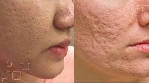 Phương pháp điều trị sẹo hiệu quả nhất hiện nay