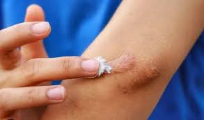 phòng ngừa sẹo