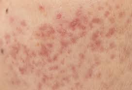 Tăng Sắc Tố Sau Viêm