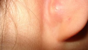 mụn ẩn ở tai
