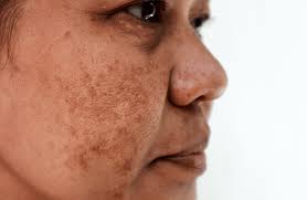 cơ chế hình thành nám để phòng ngừa