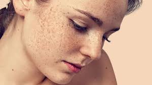 Top 7 Cách Trị Tàn Nhang Hiệu Quả Bạn Nên Biết