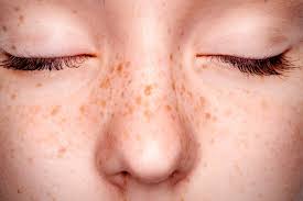 Tăng sắc tố sau lazer